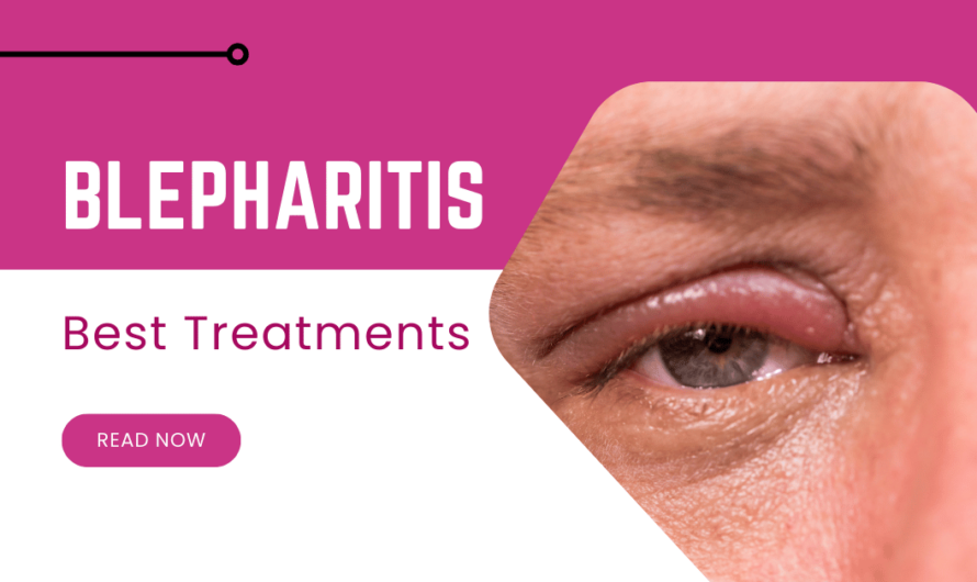 Blepharitis Guide: Causes, Symptoms & Best Treatments