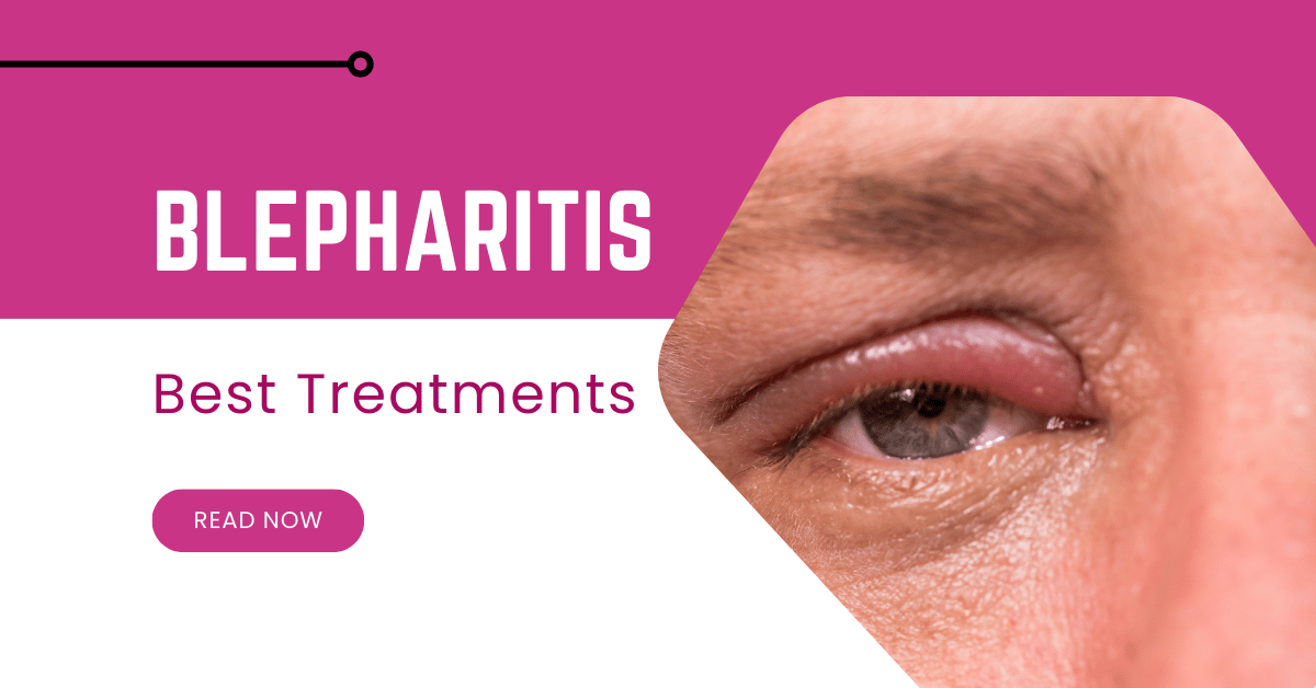 Blepharitis Guide: Causes, Symptoms & Best Treatments