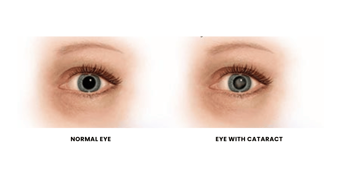 What Are Cataracts?