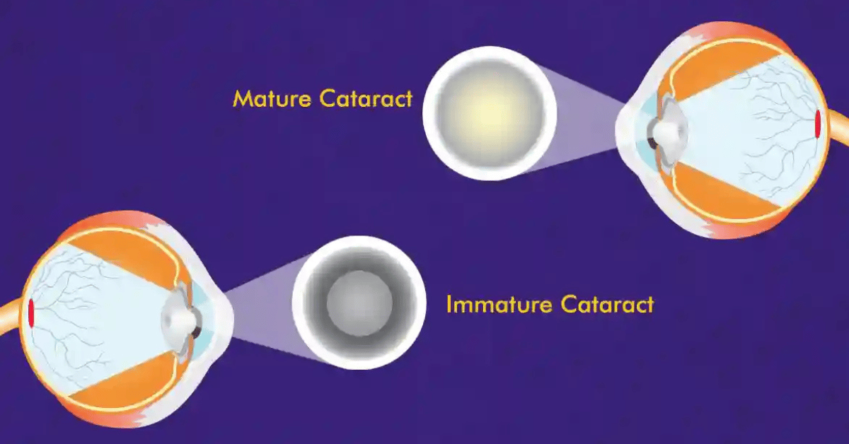 Causes and Symptoms of Mature and Immature Cataracts