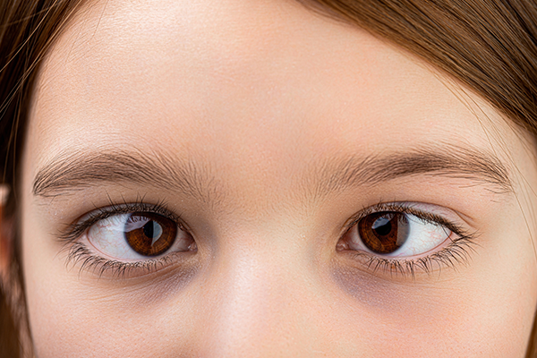 Understanding Squint Eyes (Strabismus)