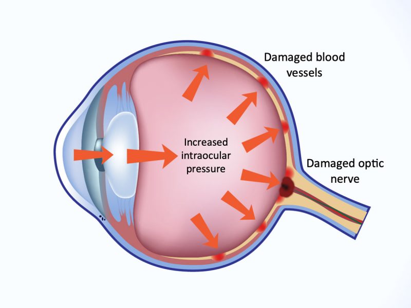 Understanding Eye Pressure: The Basics